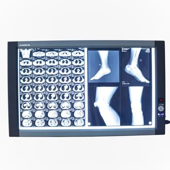 led x ışını görüntüleyici negatoskop tıbbi x-ışını x-ışını filmleri negatoskop fiyatı